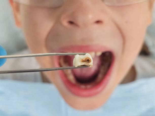 Best Emergency Gum Treatment in De Soto, IL