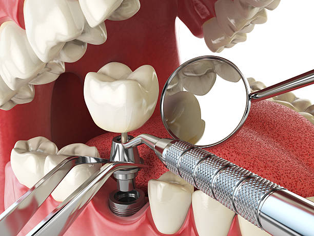 Best Emergency Wisdom Teeth Removal in De Soto, IL